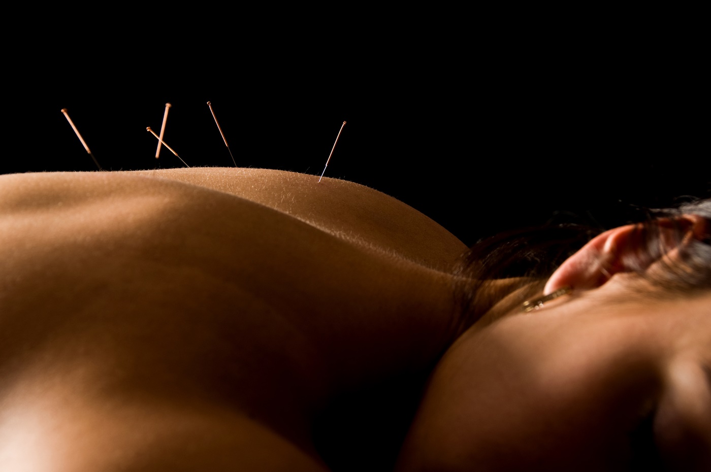 Woman with Acupuncture Needles in Back